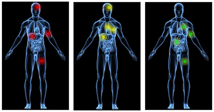 Analysis of metastatic prostate cancers suggests treatment options